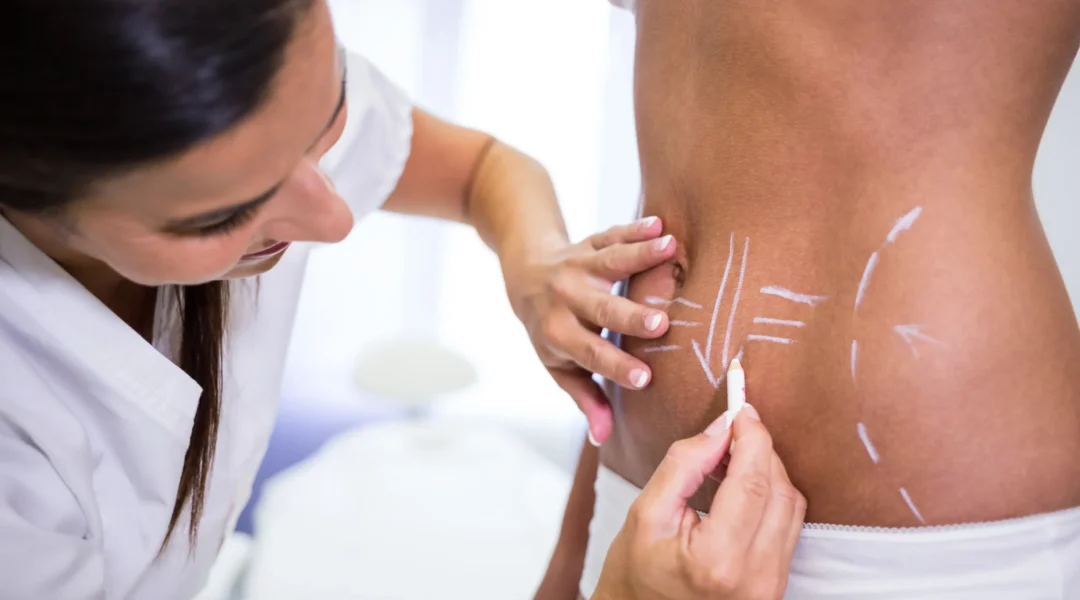 surgeon-drawing-lines-womans-abdomen-liposuction-cellulite-removal